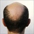 hair-loss-alopecia7.jpg